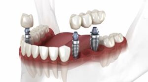 dental treatments implant