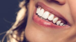 dental treatments hollywood smile